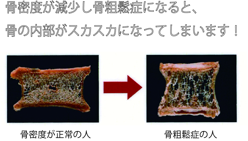 今からできる 骨粗鬆症にならないために骨を強くする３つの対策 株式会社メディケアー